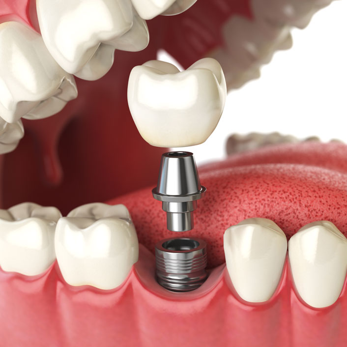 Implants - Dental Services